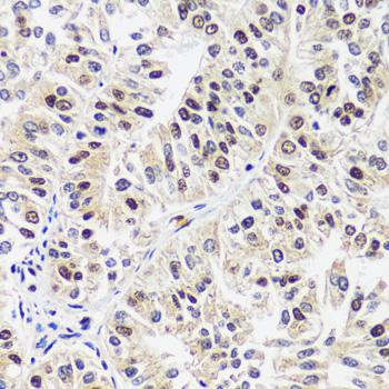 TIP120 / CAND1 Antibody - Immunohistochemistry of paraffin-embedded Human uterine cancer using CAND1 Polyclonal Antibody at dilution of 1:100 (40x lens).