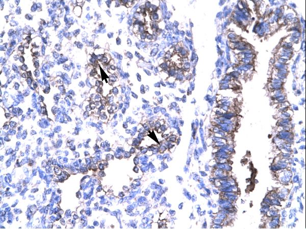 TIP30 / HTATIP2 Antibody - HTATIP2 / TIP30 antibody ARP32774_T100-NP_006401-HTATIP2 (HIV-1 Tat interactive protein 2, 30kDa) Antibody was used in IHC to stain formalin-fixed, paraffin-embedded human lung.  This image was taken for the unconjugated form of this product. Other forms have not been tested.