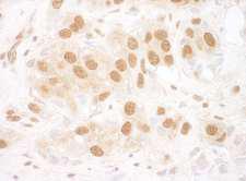 TIP48 / RUVBL2 Antibody - Detection of Human RuvBL2 by Immunohistochemistry. Sample: FFPE section of human breast carcinoma. Antibody: Affinity purified rabbit anti-RuvBL2 used at a dilution of 1:1000 (1 ug/ml). Detection: DAB.