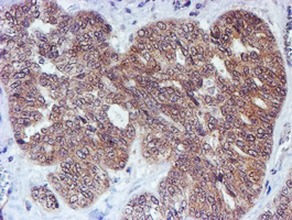 TIP48 / RUVBL2 Antibody - IHC of paraffin-embedded Adenocarcinoma of Human ovary tissue using anti-RUVBL2 mouse monoclonal antibody.
