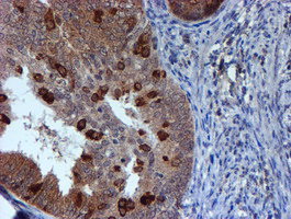 TIP48 / RUVBL2 Antibody - IHC of paraffin-embedded Adenocarcinoma of Human endometrium tissue using anti-RUVBL2 mouse monoclonal antibody.
