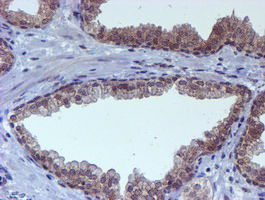TIP48 / RUVBL2 Antibody - IHC of paraffin-embedded Carcinoma of Human prostate tissue using anti-RUVBL2 mouse monoclonal antibody.