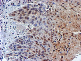 TIP48 / RUVBL2 Antibody - IHC of paraffin-embedded Carcinoma of Human bladder tissue using anti-RUVBL2 mouse monoclonal antibody.