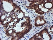 TIP48 / RUVBL2 Antibody - IHC of paraffin-embedded Adenocarcinoma of Human colon tissue using anti-RUVBL2 mouse monoclonal antibody.