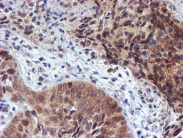 TIP48 / RUVBL2 Antibody - IHC of paraffin-embedded Carcinoma of Human lung tissue using anti-RUVBL2 mouse monoclonal antibody.