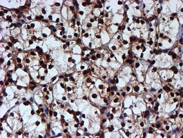 TIP48 / RUVBL2 Antibody - IHC of paraffin-embedded Carcinoma of Human kidney tissue using anti-RUVBL2 mouse monoclonal antibody.