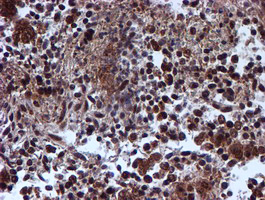 TIP48 / RUVBL2 Antibody - IHC of paraffin-embedded Adenocarcinoma of Human ovary tissue using anti-RUVBL2 mouse monoclonal antibody.