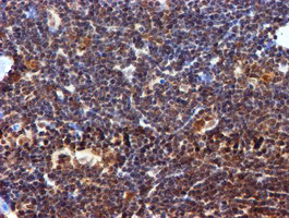 TIP48 / RUVBL2 Antibody - IHC of paraffin-embedded Human lymphoma tissue using anti-RUVBL2 mouse monoclonal antibody.