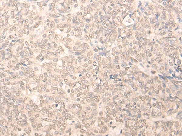 TIP48 / RUVBL2 Antibody - Immunohistochemistry of paraffin-embedded Human ovarian cancer tissue  using RUVBL2 Polyclonal Antibody at dilution of 1:25(×200)