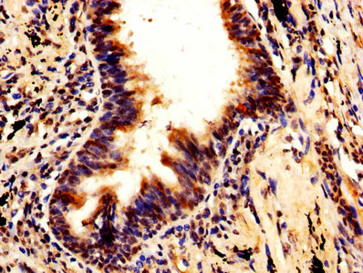 TIP49 / RUVBL1 Antibody - IHC image of RUVBL1 Antibody diluted at 1:600 and staining in paraffin-embedded human lung cancer performed on a Leica BondTM system. After dewaxing and hydration, antigen retrieval was mediated by high pressure in a citrate buffer (pH 6.0). Section was blocked with 10% normal goat serum 30min at RT. Then primary antibody (1% BSA) was incubated at 4°C overnight. The primary is detected by a biotinylated secondary antibody and visualized using an HRP conjugated SP system.