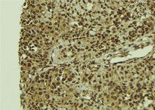 TIP49 / RUVBL1 Antibody - 1:100 staining human breast carcinoma tissue by IHC-P. The sample was formaldehyde fixed and a heat mediated antigen retrieval step in citrate buffer was performed. The sample was then blocked and incubated with the antibody for 1.5 hours at 22°C. An HRP conjugated goat anti-rabbit antibody was used as the secondary.