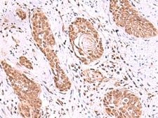 TIP49 / RUVBL1 Antibody - Immunohistochemistry of paraffin-embedded Human esophagus cancer tissue  using RUVBL1 Polyclonal Antibody at dilution of 1:85(×200)