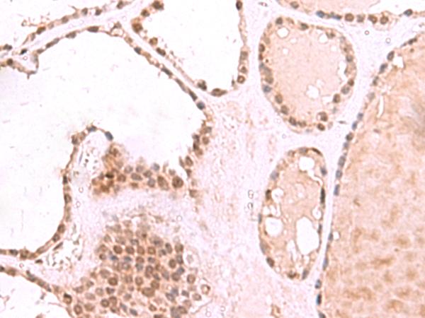 TIP49 / RUVBL1 Antibody - Immunohistochemistry of paraffin-embedded Human thyroid cancer tissue  using RUVBL1 Polyclonal Antibody at dilution of 1:85(×200)