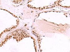 TIP49 / RUVBL1 Antibody - Immunohistochemistry of paraffin-embedded Human thyroid cancer tissue  using RUVBL1 Polyclonal Antibody at dilution of 1:65(×200)