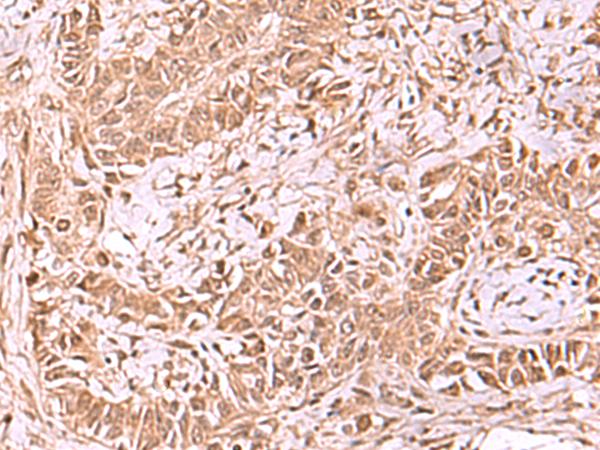 TIP49 / RUVBL1 Antibody - Immunohistochemistry of paraffin-embedded Human ovarian cancer tissue  using RUVBL1 Polyclonal Antibody at dilution of 1:65(×200)