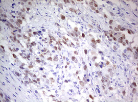 TIPIN Antibody - IHC of paraffin-embedded Adenocarcinoma of Human ovary tissue using anti-TIPIN mouse monoclonal antibody. (Heat-induced epitope retrieval by 10mM citric buffer, pH6.0, 120°C for 3min).