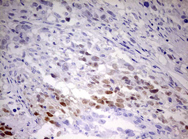 TIPIN Antibody - IHC of paraffin-embedded Adenocarcinoma of Human ovary tissue using anti-TIPIN mouse monoclonal antibody. (Heat-induced epitope retrieval by 10mM citric buffer, pH6.0, 120°C for 3min).
