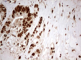 TIPIN Antibody - IHC of paraffin-embedded Adenocarcinoma of Human colon tissue using anti-TIPIN mouse monoclonal antibody. (Heat-induced epitope retrieval by 10mM citric buffer, pH6.0, 120°C for 3min).