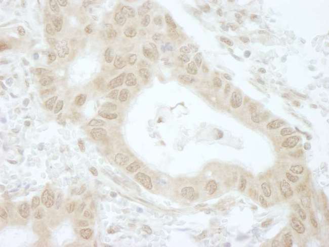TIPRL / TIP Antibody - Detection of Human Tip41 by Immunohistochemistry. Sample: FFPE section of human lung adenocarcinoma. Antibody: Affinity purified rabbit anti-Tip41 used at a dilution of 1:250.
