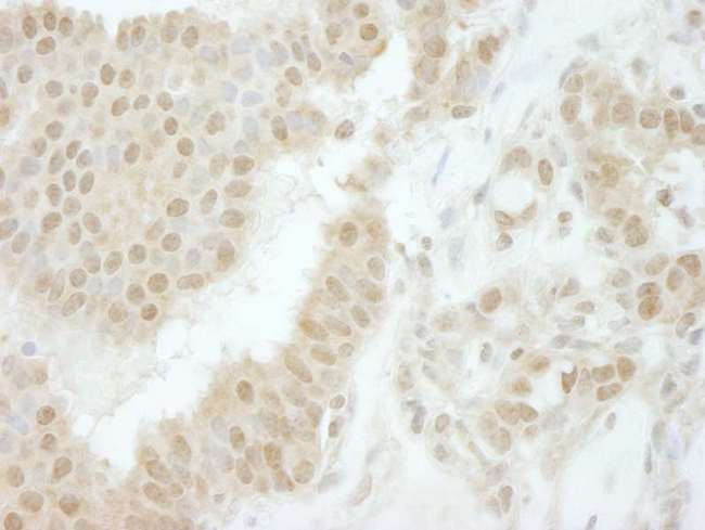 TIPRL / TIP Antibody - Detection of Human Tip41 by Immunohistochemistry. Sample: FFPE section of human breast carcinoma. Antibody: Affinity purified rabbit anti-Tip41 used at a dilution of 1:250.