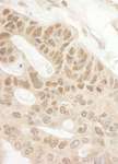 TIPRL / TIP Antibody - Detection of Human Tip41 by Immunohistochemistry. Sample: FFPE section of human ovarian carcinoma. Antibody: Affinity purified rabbit anti-Tip41 used at a dilution of 1:200 (1 ug/ml). Detection: DAB.