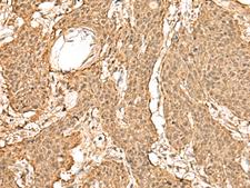 TIPRL / TIP Antibody - Immunohistochemistry of paraffin-embedded Human esophagus cancer tissue  using TIPRL Polyclonal Antibody at dilution of 1:60(×200)