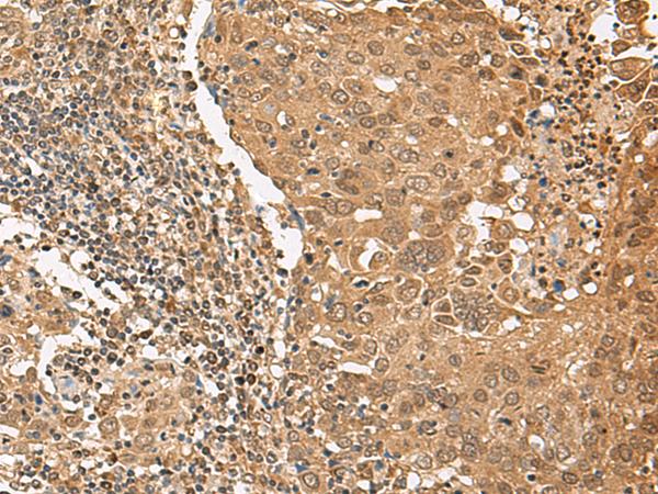 TIPRL / TIP Antibody - Immunohistochemistry of paraffin-embedded Human cervical cancer tissue  using TIPRL Polyclonal Antibody at dilution of 1:65(×200)
