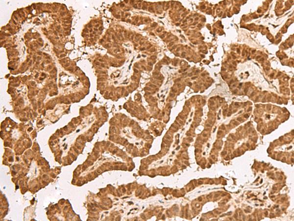 TIPRL / TIP Antibody - Immunohistochemistry of paraffin-embedded Human thyroid cancer tissue  using TIPRL Polyclonal Antibody at dilution of 1:65(×200)