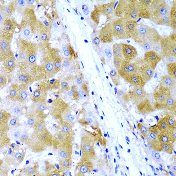 TIRAP Antibody - Immunohistochemistry of paraffin-embedded human liver cancer tissue.