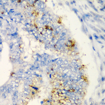 TIRAP Antibody - Immunohistochemistry of paraffin-embedded human colon carcinoma tissue.