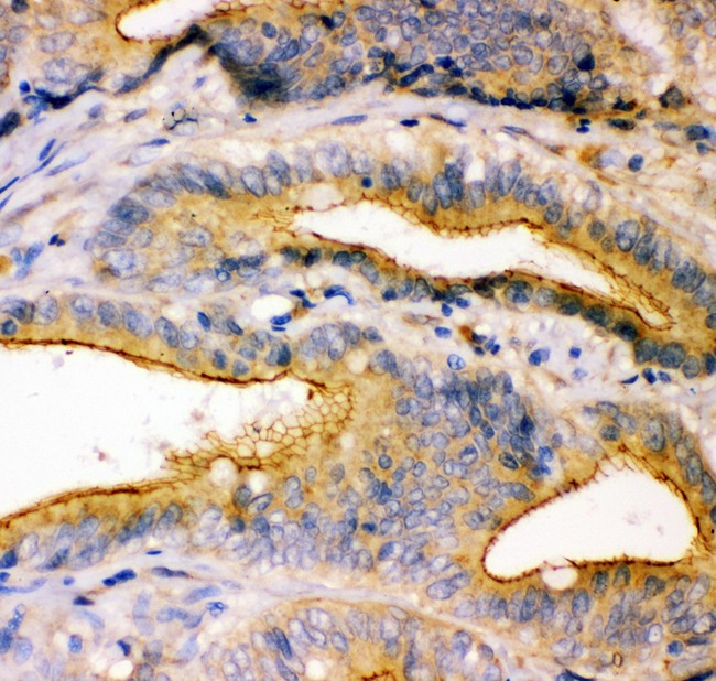 TJP1 / ZO-1 Antibody - TJP1 antibody IHC-paraffin: Human Intestinal Cancer Tissue.