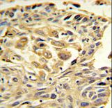 TJP1 / ZO-1 Antibody - ZO1 Antibody IHC of formalin-fixed and paraffin-embedded lung carcinoma followed by peroxidase-conjugated secondary antibody and DAB staining.