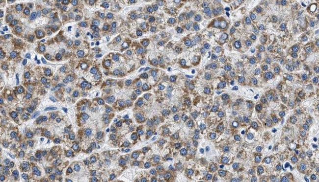 TJP1 / ZO-1 Antibody - 1:100 staining human liver carcinoma tissues by IHC-P. The sample was formaldehyde fixed and a heat mediated antigen retrieval step in citrate buffer was performed. The sample was then blocked and incubated with the antibody for 1.5 hours at 22°C. An HRP conjugated goat anti-rabbit antibody was used as the secondary.
