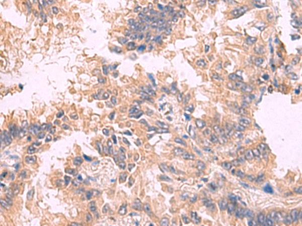 TJP1 / ZO-1 Antibody - Immunohistochemistry of paraffin-embedded Human lung cancer tissue  using TJP1 Polyclonal Antibody at dilution of 1:30(×200)