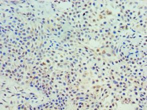 TK1 / TK / Thymidine Kinase Antibody - Immunohistochemistry of paraffin-embedded human breast cancer using antibody at 1:100 dilution.
