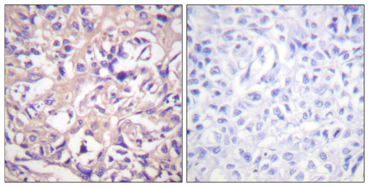TK1 / TK / Thymidine Kinase Antibody - Immunohistochemistry analysis of paraffin-embedded human breast carcinoma tissue, using TK Antibody. The picture on the right is blocked with the synthesized peptide.