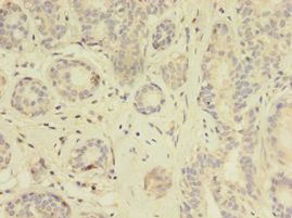 TK1 / TK / Thymidine Kinase Antibody - Immunohistochemistry of paraffin-embedded human breast cancer using antibody at 1: 100 dilution.  This image was taken for the unconjugated form of this product. Other forms have not been tested.