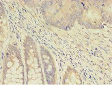 TK1 / TK / Thymidine Kinase Antibody - Immunohistochemistry of paraffin-embedded human colon cancer using antibody at 1:100 dilution.  This image was taken for the unconjugated form of this product. Other forms have not been tested.