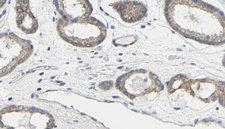 TK1 / TK / Thymidine Kinase Antibody - 1:100 staining human prostate tissue by IHC-P. The sample was formaldehyde fixed and a heat mediated antigen retrieval step in citrate buffer was performed. The sample was then blocked and incubated with the antibody for 1.5 hours at 22°C. An HRP conjugated goat anti-rabbit antibody was used as the secondary.