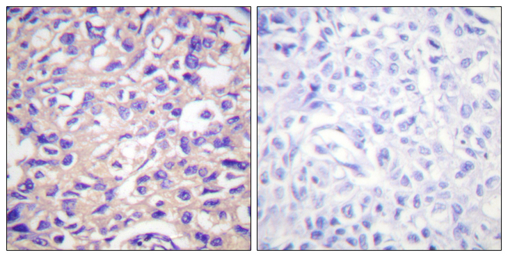 TK1 / TK / Thymidine Kinase Antibody - Immunohistochemistry analysis of paraffin-embedded human breast carcinoma, using TK (Phospho-Ser13) Antibody. The picture on the right is blocked with the phospho peptide.