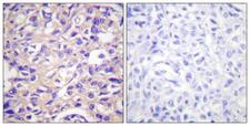 TK1 / TK / Thymidine Kinase Antibody - Immunohistochemistry analysis of paraffin-embedded human breast carcinoma, using TK (Phospho-Ser13) Antibody. The picture on the right is blocked with the phospho peptide.