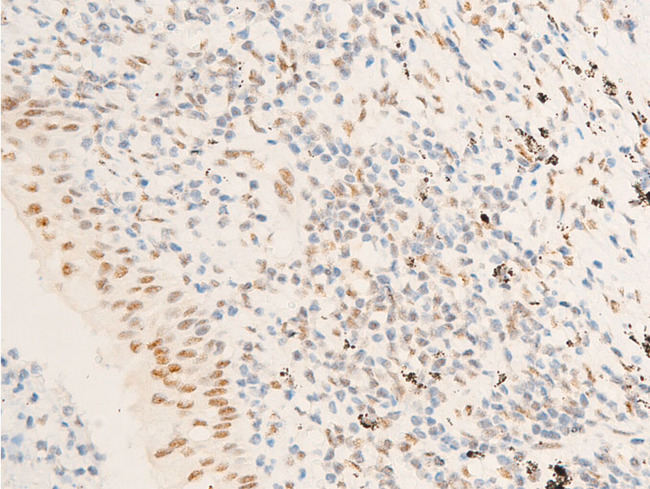 TK1 / TK / Thymidine Kinase Antibody - 1:100 staining human TB tissue by IHC-P. The tissue was formaldehyde fixed and a heat mediated antigen retrieval step in citrate buffer was performed. The tissue was then blocked and incubated with the antibody for 1.5 hours at 22°C. An HRP conjugated goat anti-rabbit antibody was used as the secondary.