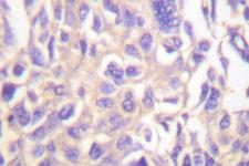 TK1 / TK / Thymidine Kinase Antibody - IHC of TK (P7) pAb in paraffin-embedded human breast carcinoma tissue.