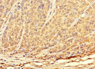 TKTL2 Antibody - Immunohistochemistry of paraffin-embedded human ovarian cancer using TKTL2 Antibody at dilution of 1:100