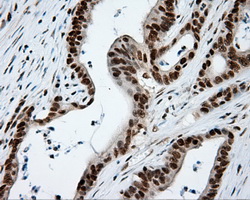 TLDC1 / KIAA1609 Antibody - IHC of paraffin-embedded Adenocarcinoma of colon tissue using anti-KIAA1609 mouse monoclonal antibody. (Heat-induced epitope retrieval by 10mM citric buffer, pH6.0, 100C for 10min, Dilution 1:50).
