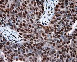 TLDC1 / KIAA1609 Antibody - IHC of paraffin-embedded Adenocarcinoma of ovary tissue using anti-KIAA1609 mouse monoclonal antibody. (Heat-induced epitope retrieval by 10mM citric buffer, pH6.0, 100C for 10min, Dilution 1:50).