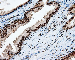 TLDC1 / KIAA1609 Antibody - IHC of paraffin-embedded prostate tissue using anti-KIAA1609 mouse monoclonal antibody. (Heat-induced epitope retrieval by 10mM citric buffer, pH6.0, 100C for 10min, Dilution 1:50).