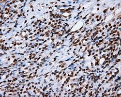 TLDC1 / KIAA1609 Antibody - IHC of paraffin-embedded Carcinoma of thyroid tissue using anti-KIAA1609 mouse monoclonal antibody. (Heat-induced epitope retrieval by 10mM citric buffer, pH6.0, 100C for 10min, Dilution 1:50).