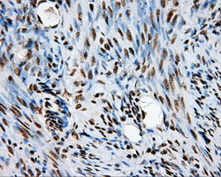 TLDC1 / KIAA1609 Antibody - IHC of paraffin-embedded endometrium tissue using anti-KIAA1609 mouse monoclonal antibody. (Heat-induced epitope retrieval by 10mM citric buffer, pH6.0, 100C for 10min, Dilution 1:50).