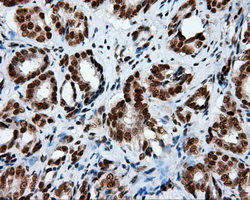 TLDC1 / KIAA1609 Antibody - IHC of paraffin-embedded Carcinoma of prostate tissue using anti-KIAA1609 mouse monoclonal antibody. (Heat-induced epitope retrieval by 10mM citric buffer, pH6.0, 100C for 10min, Dilution 1:50).